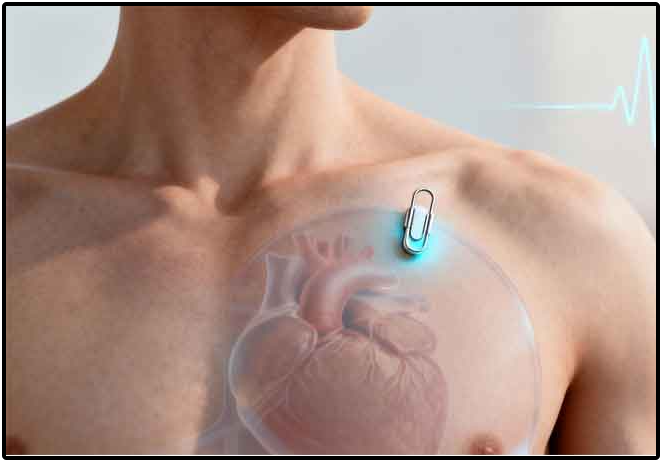 Implantable Loop Recorder Implantable Loop Recorder