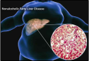 Effect of Yacrujjay tablets in Hypercholesterolemia induced NAFLD Non-Alcoholic-Fatty-Liver-Disease-(NAFLD)-stroke
