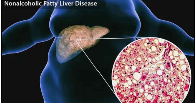 Non-Alcoholic-Fatty-Liver-Disease-(NAFLD)-stroke