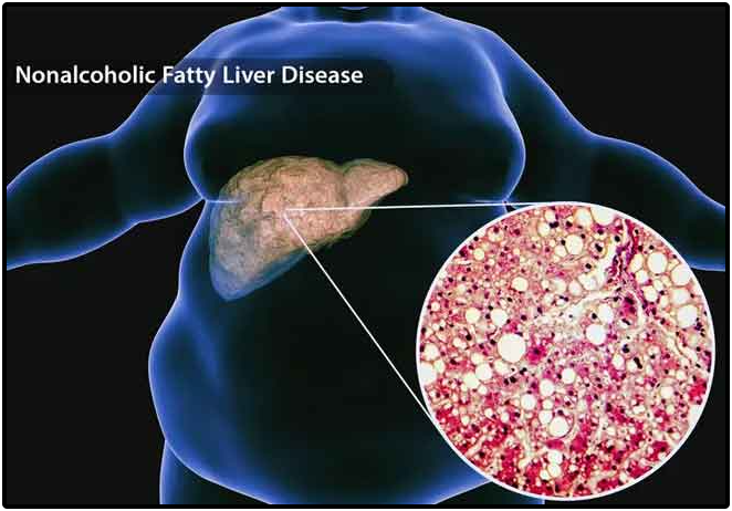 Non Alcoholic Fatty Liver-Disease (NAFLD) Non-Alcoholic-Fatty-Liver-Disease-(NAFLD)