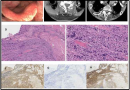 Plasmacytoma