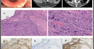 Plasmacytoma