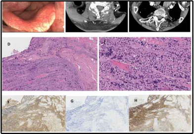 Plasmacytoma