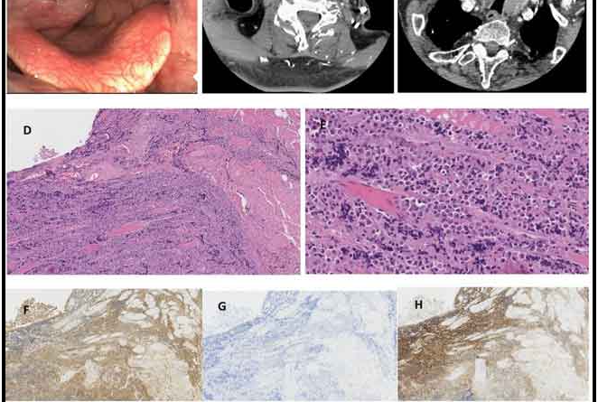 Plasmacytoma