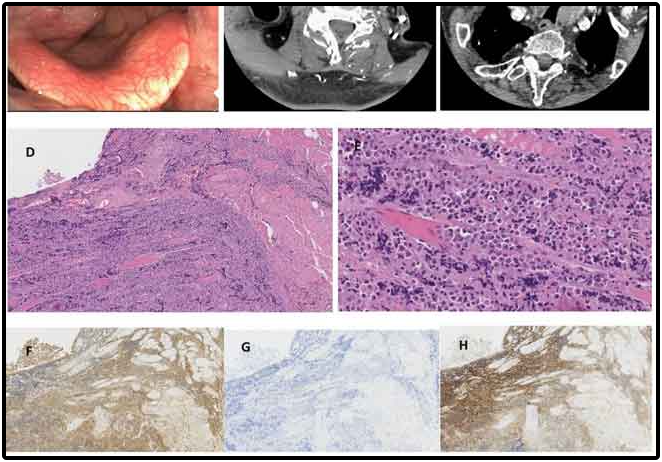Plasmacytoma Plasmacytoma