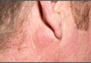 Pleomorphic Adenoma – Symptoms, Causes & Management