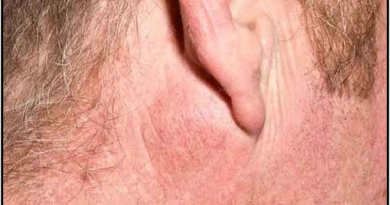 Pleomorphic Adenoma – Symptoms, Causes & Management Pleomorphic Adenoma – Symptoms, Causes & Management