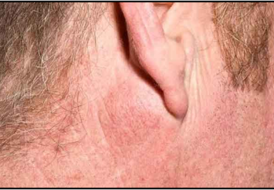 Pleomorphic Adenoma – Symptoms, Causes & Management Pleomorphic Adenoma – Symptoms, Causes & Management