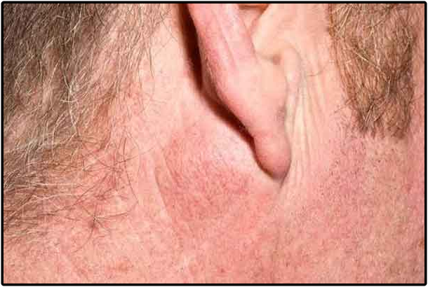 Pleomorphic Adenoma Pleomorphic Adenoma