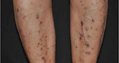 Effect of Kandu Ghan Mahakashaya in Skin Diseases As Per Ayurveda Effect of Kandu Ghan Mahakashaya in Skin Diseases As Per Ayurveda