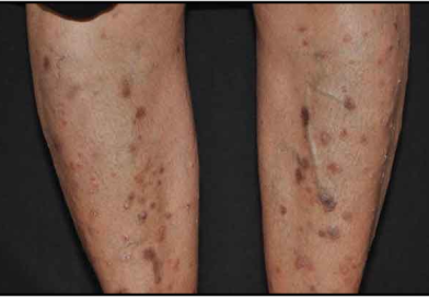 Effect of Kandu Ghan Mahakashaya in Skin Diseases As Per Ayurveda Effect of Kandu Ghan Mahakashaya in Skin Diseases As Per Ayurveda