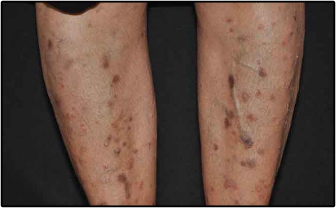 Skin Diseases Skin Diseases