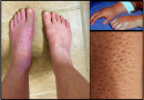 Complex Regional Pain Syndrome (CRPS) Treatment in Ayurveda