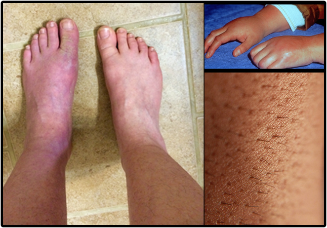Complex Regional Pain Syndrome Complex Regional Pain Syndrome