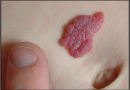 Hemangiomas , Causes, Symptoms, Key Facts & Treatment