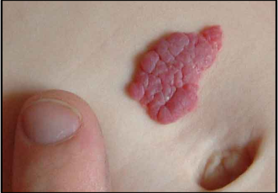 Hemangiomas , Causes, Symptoms, Key Facts & Treatment