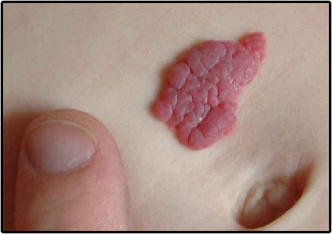 Hemangiomas Hemangiomas